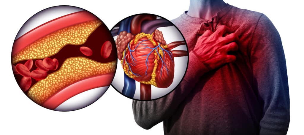 Heart attack illustration for EMTs