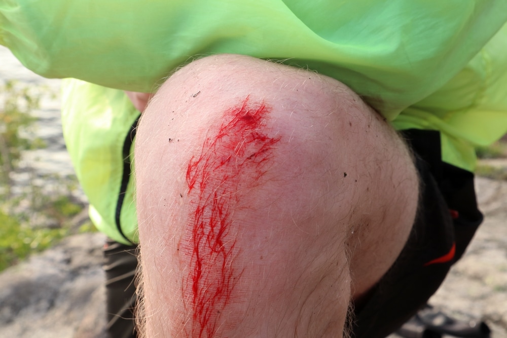 Abrasion on knee — road rash open wound example