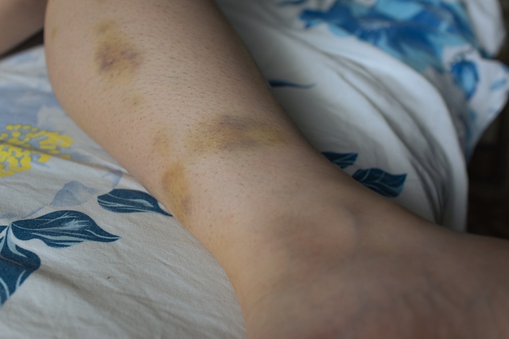 Contusions on leg — bruising indicating blunt force trauma