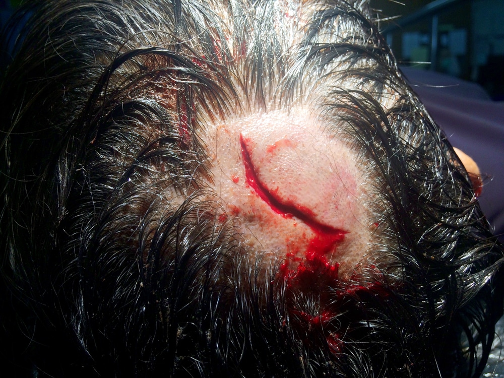 Laceration of head — serious open wound with bleeding risk
