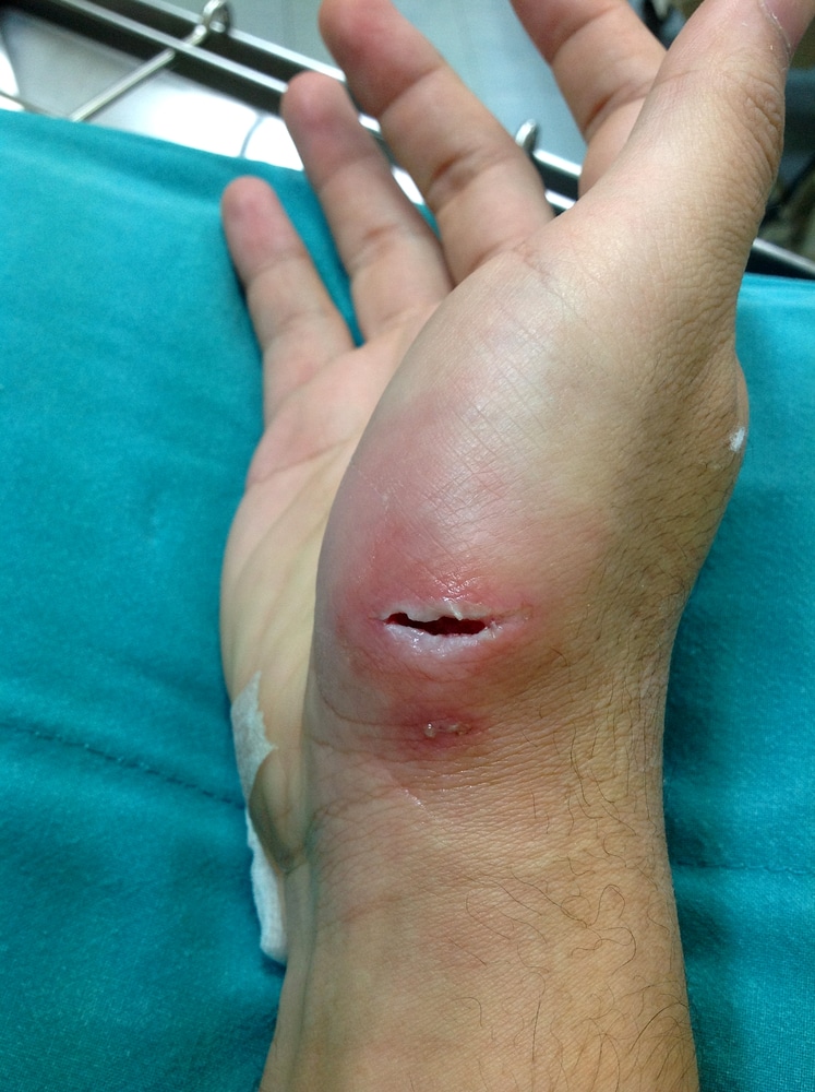 Puncture wound of hand — open wound with skin integrity violation