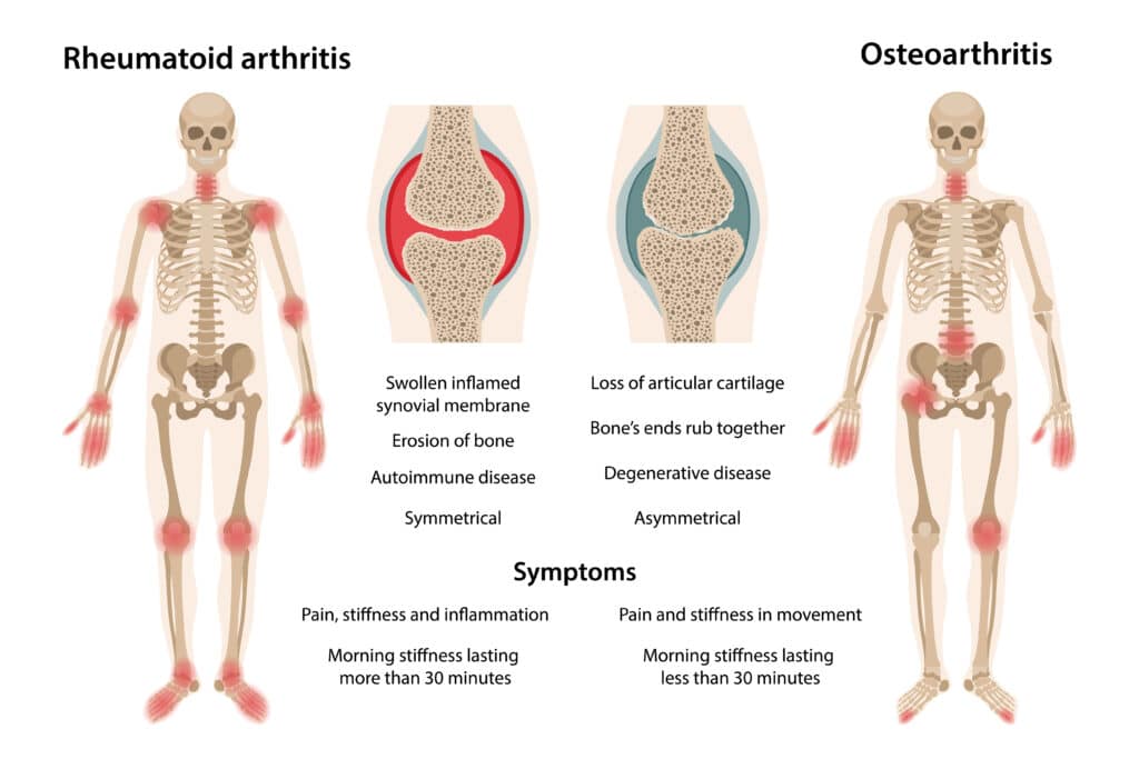 Illustration of arthritis affecting joints in the hands and knees