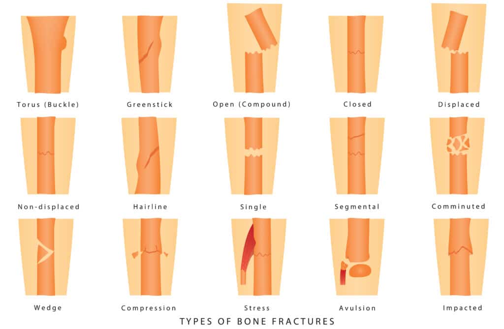 Examples of bone fracture types including closed, open, and comminuted fractures