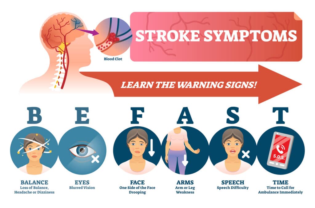 Common stroke symptoms illustration for EMT training