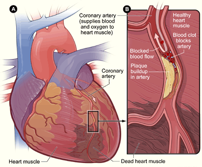 Diagram of a heart attack showing blocked coronary artery — NIH illustration